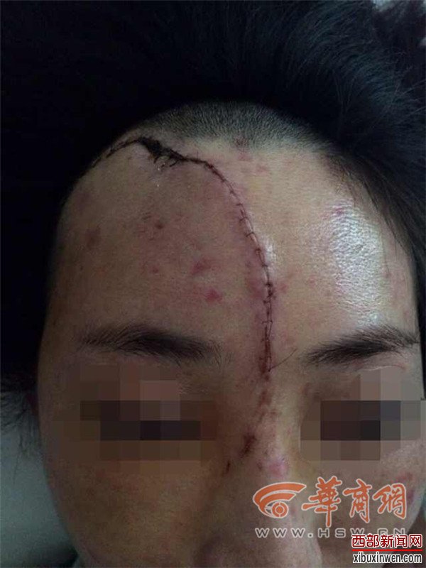 小李头部缝了170余针 华商报于卓 摄